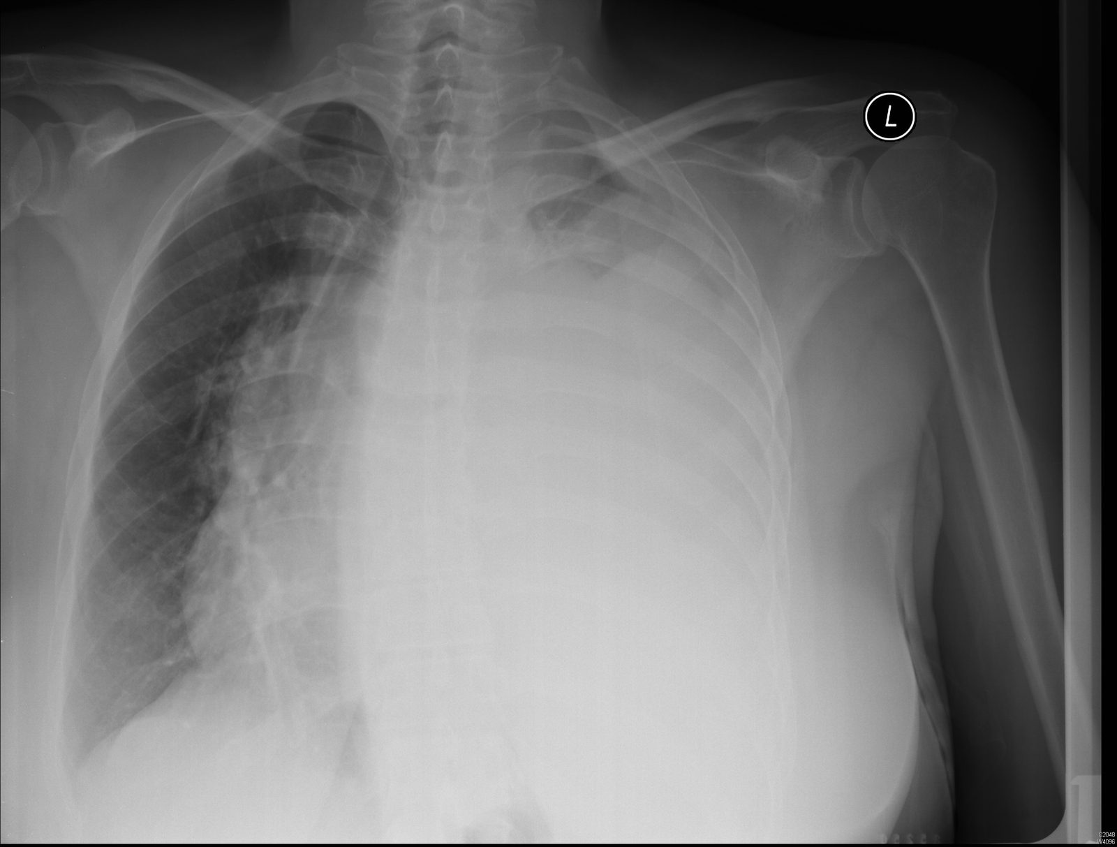 Case 02, image A: frontal chest radiograph
