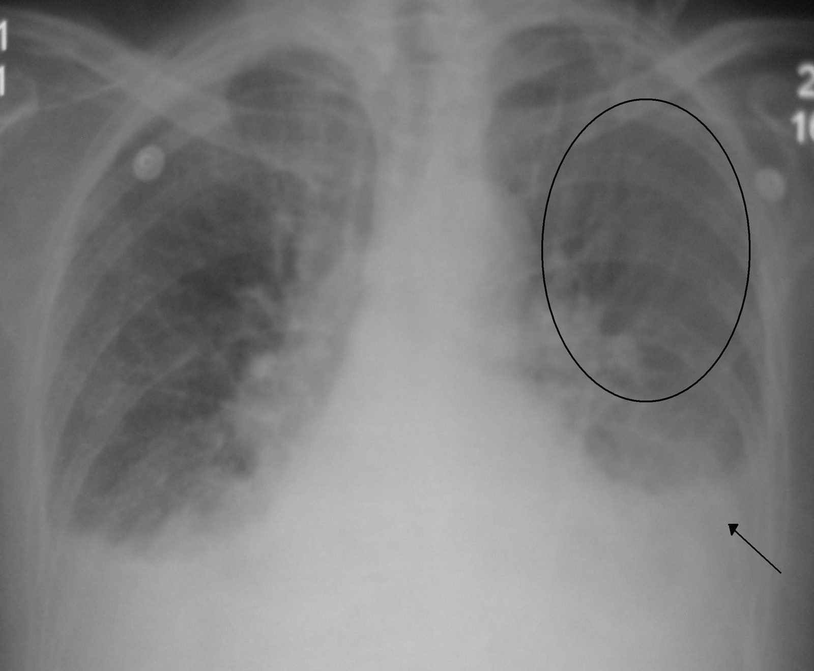 Case 04, image B: frontal chest radiograph of a second patient, with the original author's circle and arrow