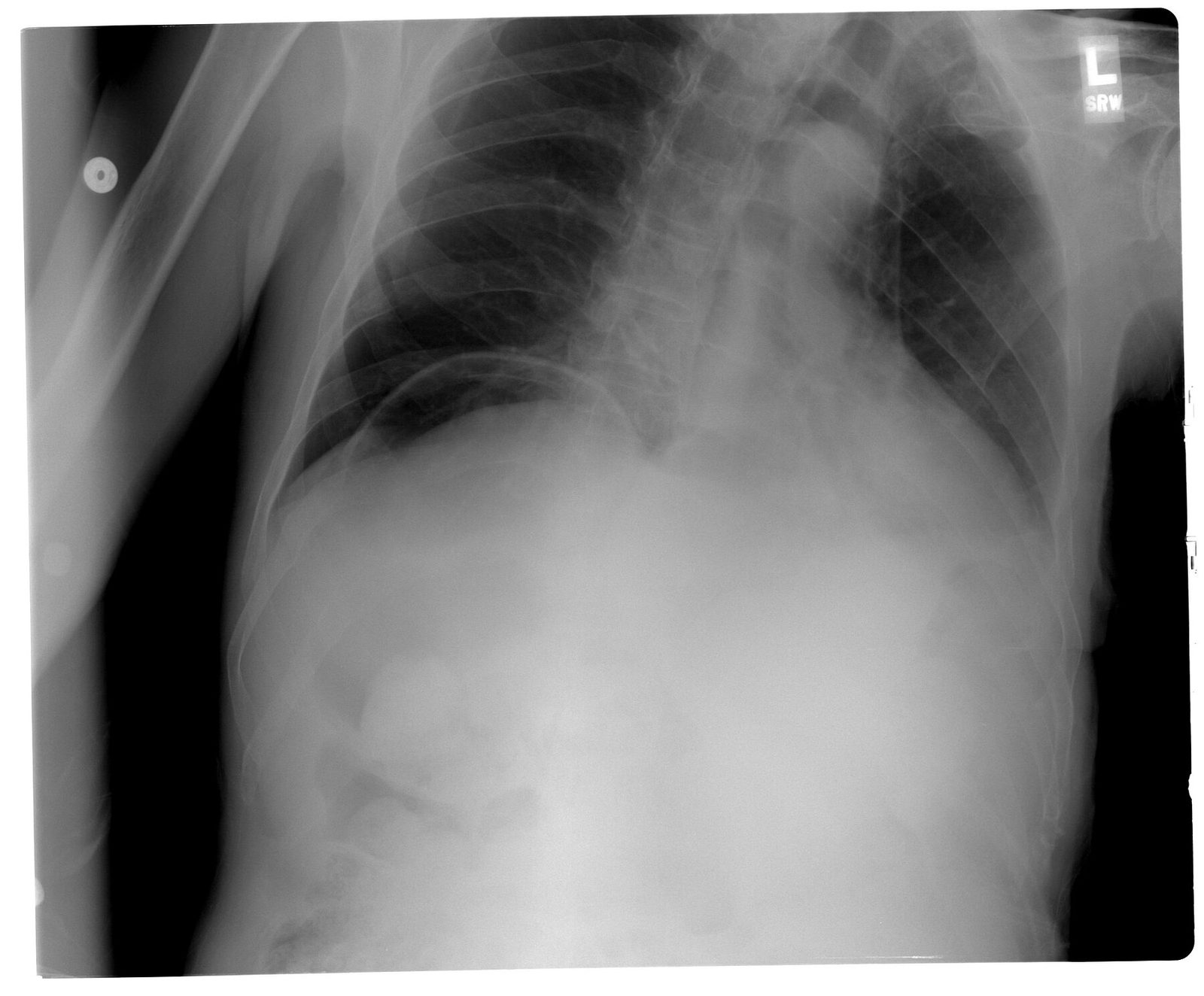 Case 05, image A: erect chest radiograph