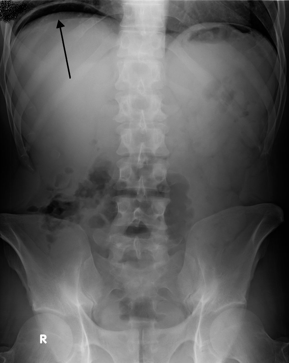 Case 05, image B: erect abdominal radiograph of a second patient, with the original author's arrow