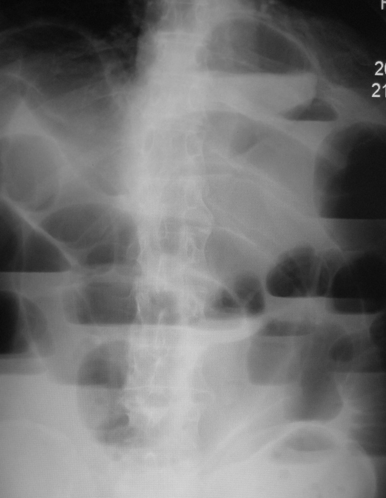Case 06, image A: upright abdominal radiograph
