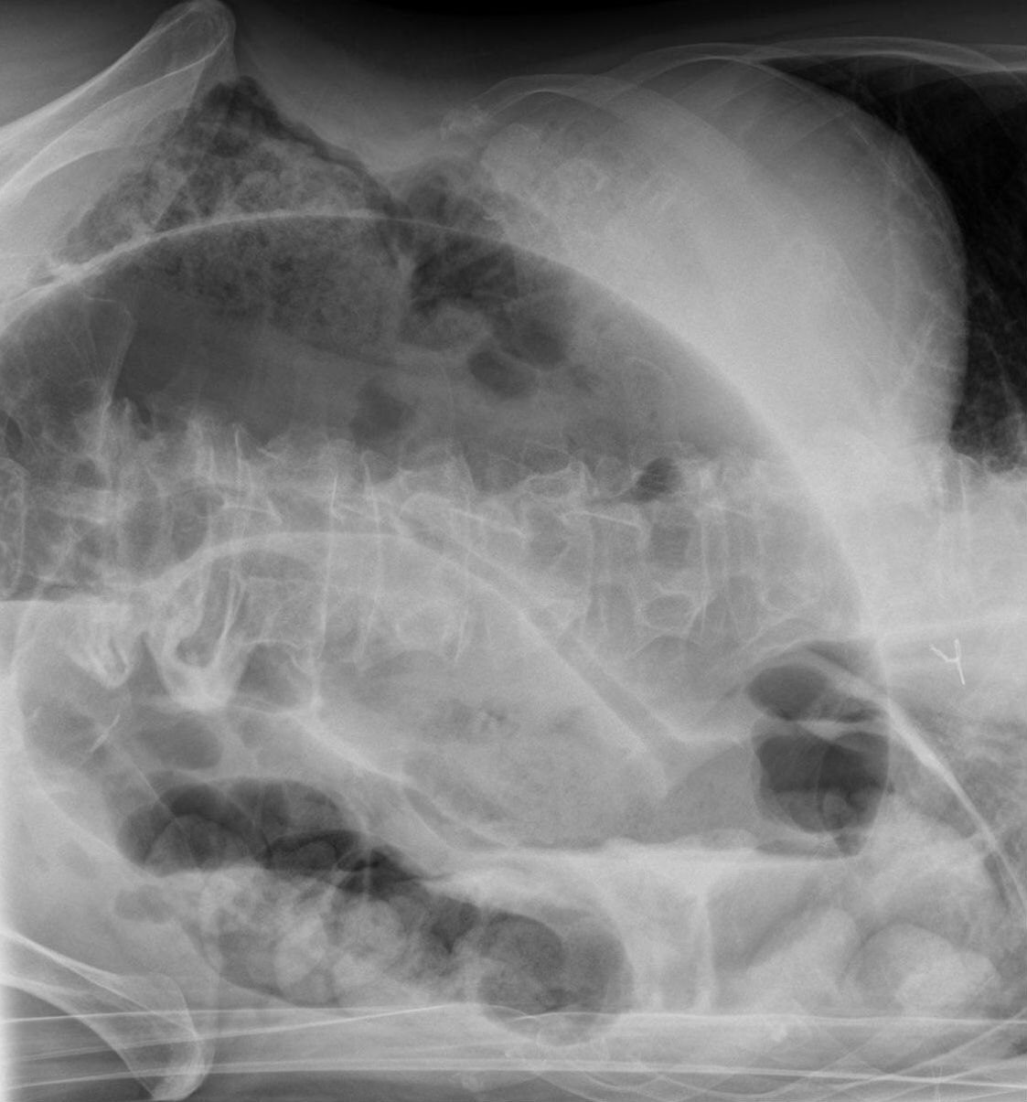 Case 07, image B: left lateral decubitus abdominal radiograph