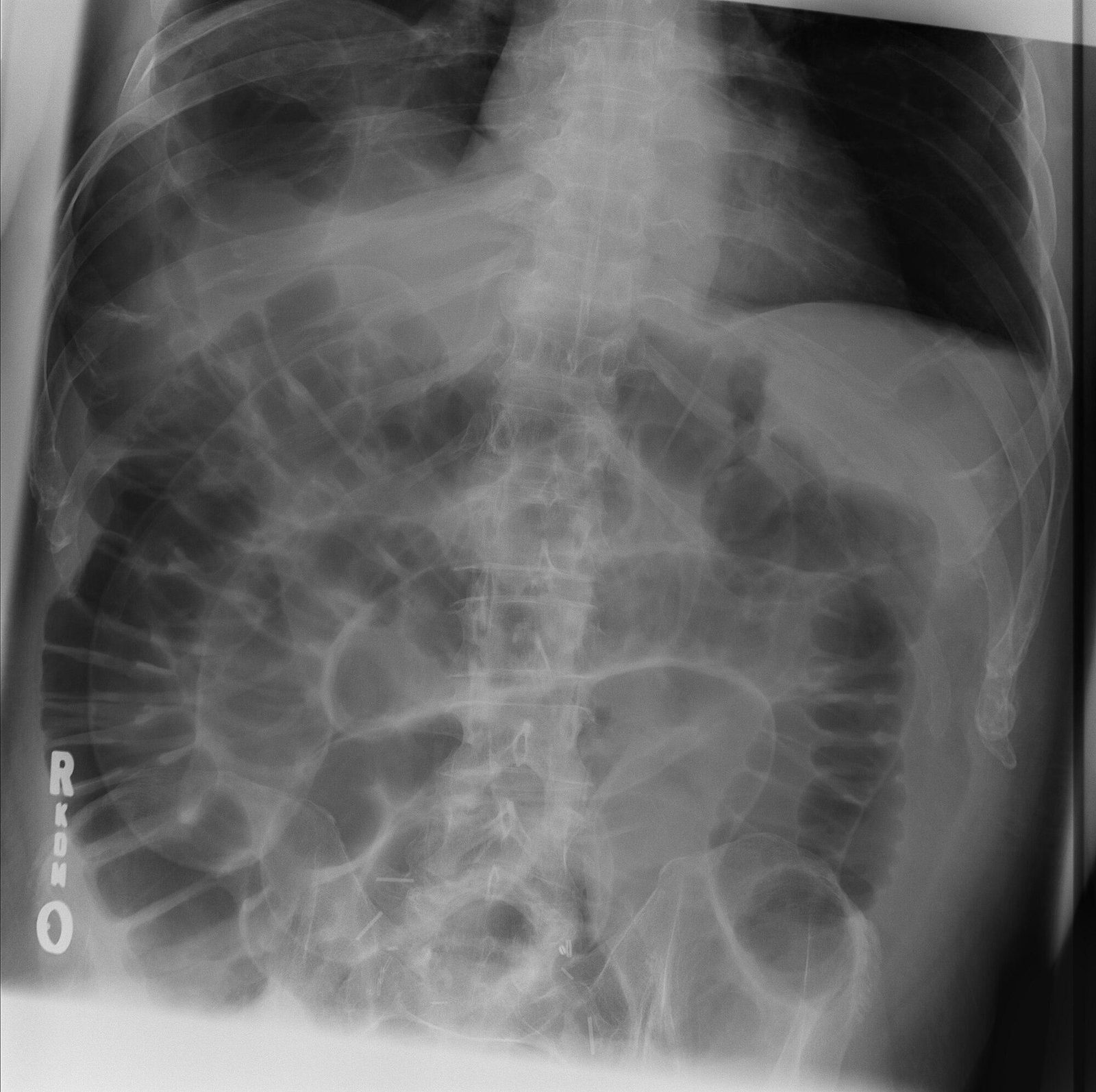 Case 08, image A: supine abdominal radiograph