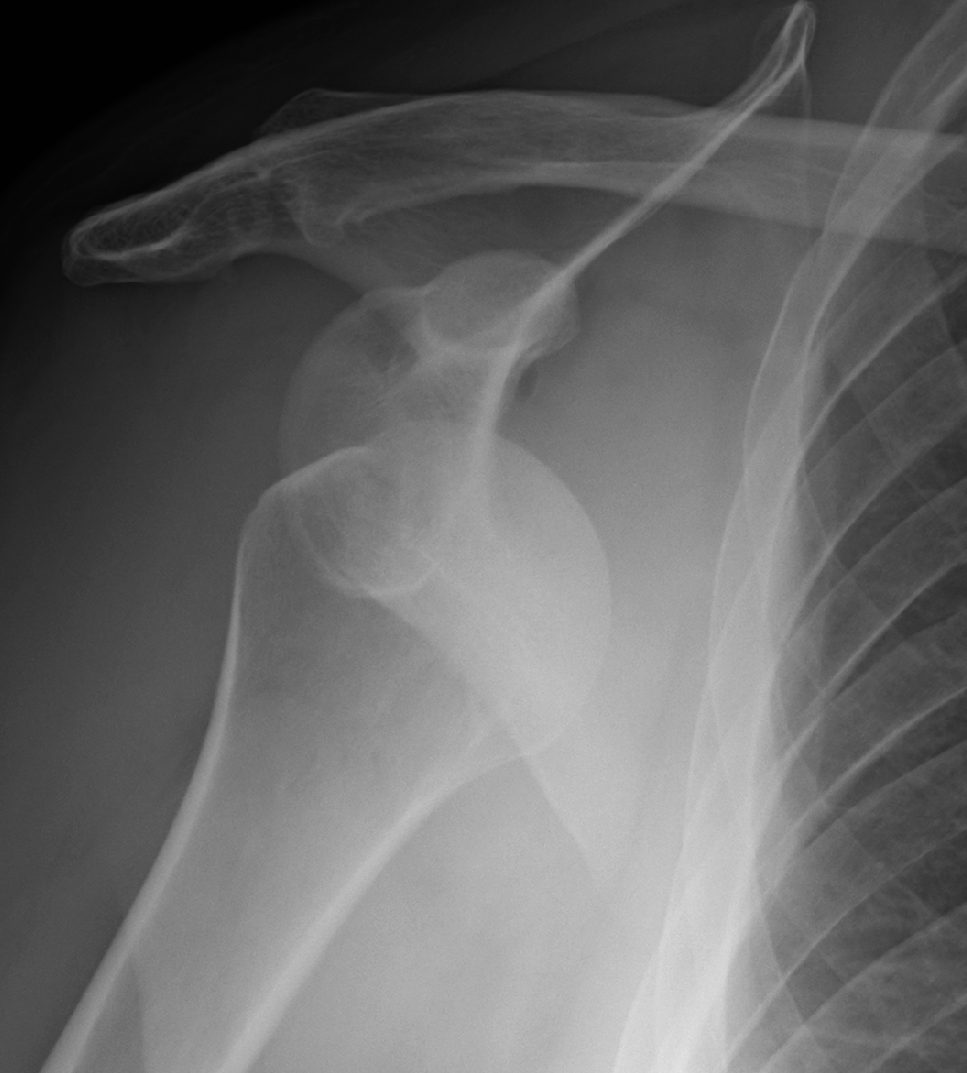Case 09, image A: AP shoulder radiograph