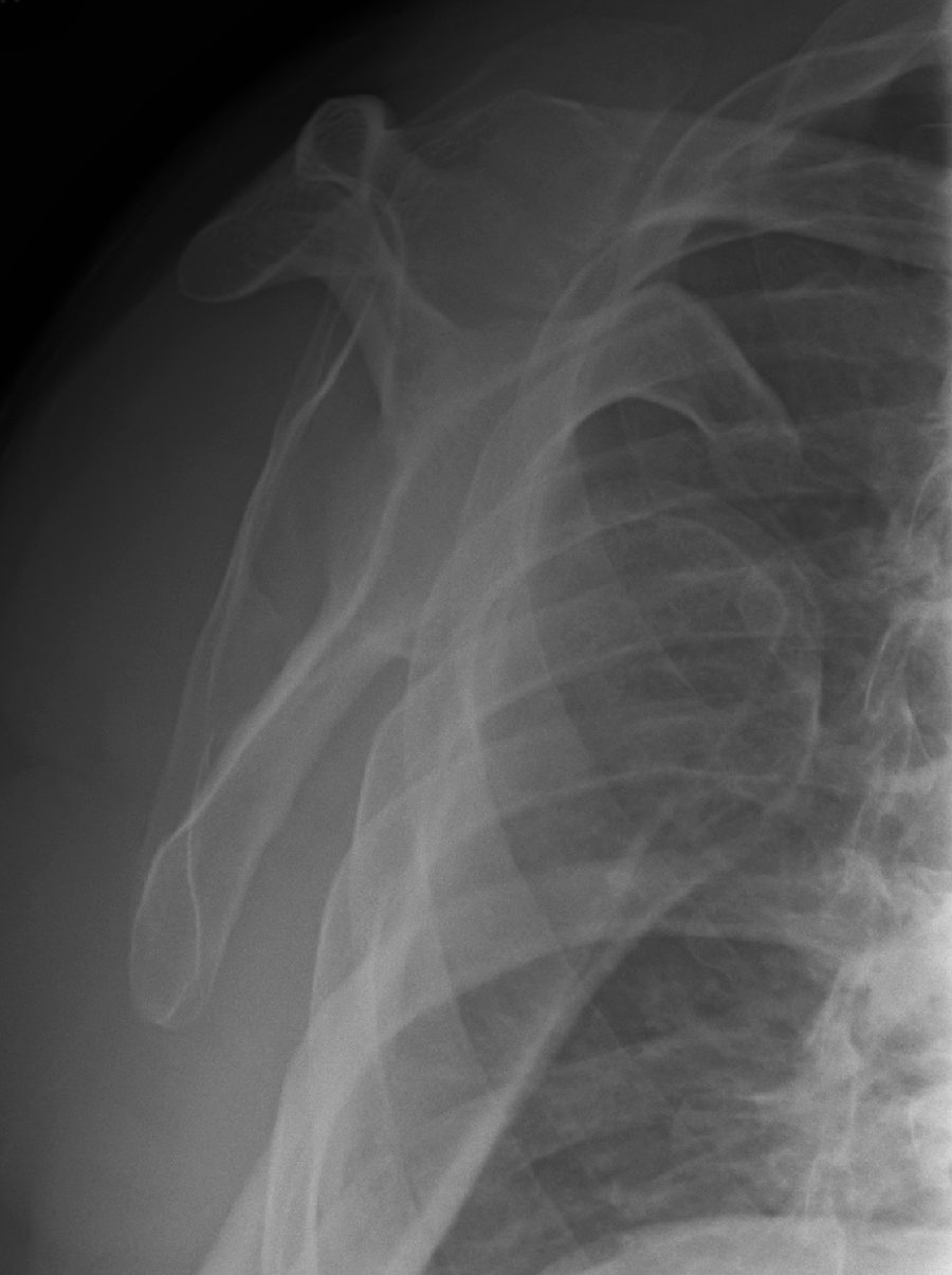Case 09, image B: scapular Y view