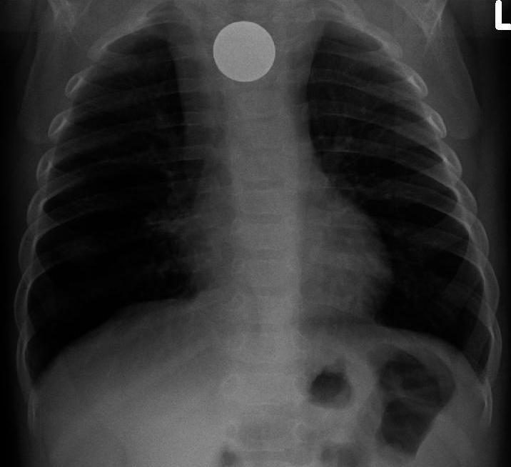 Case 10, image A: frontal chest radiograph