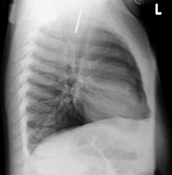 Case 10, image B: lateral chest radiograph